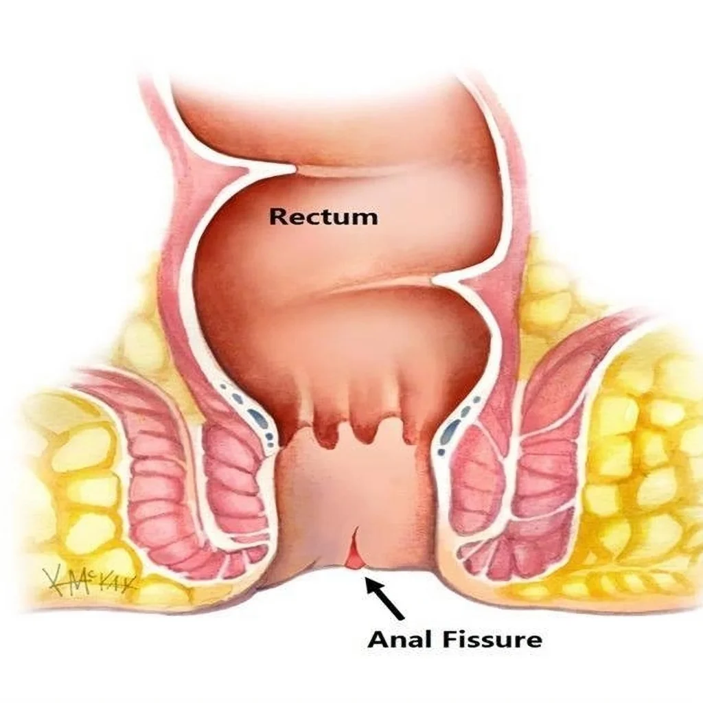Anal Fissure Treatment in Jaipur