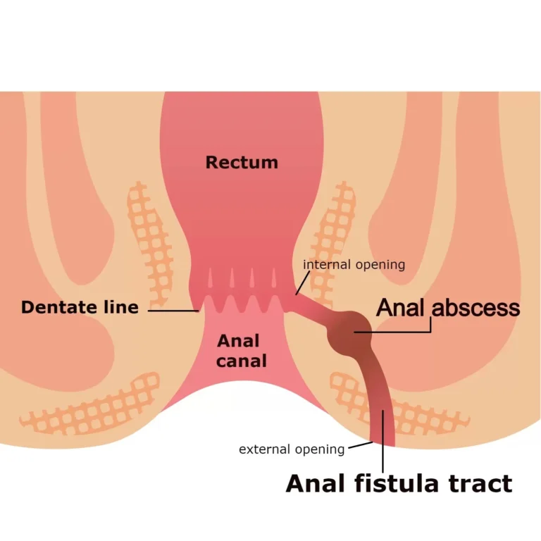 Fistula Treatment in Jaipur