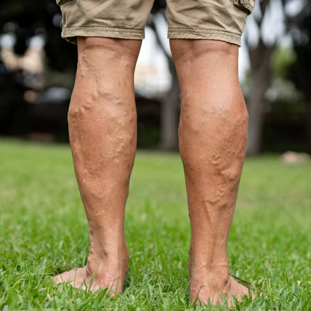 Varicose Veins Treatment in Jaipur