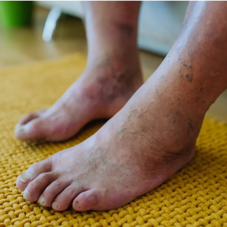 Diabetic Foot Treatment in Jaipur