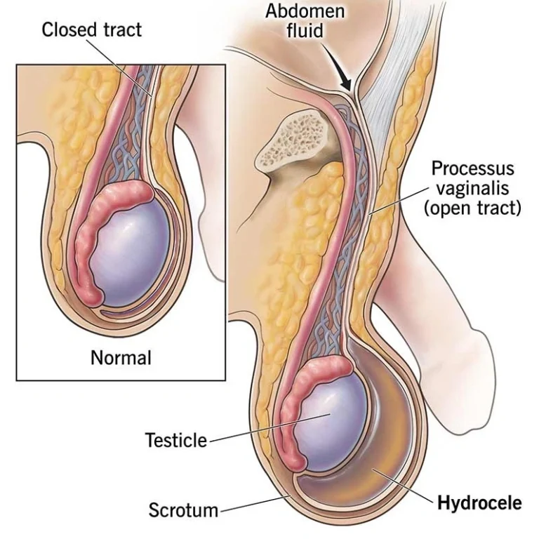 Hydrocele Treatment in Jaipur