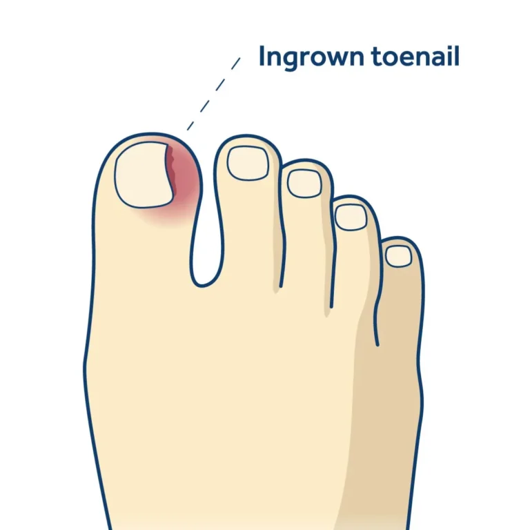Ingrowing Toenail Treatment in Jaipur