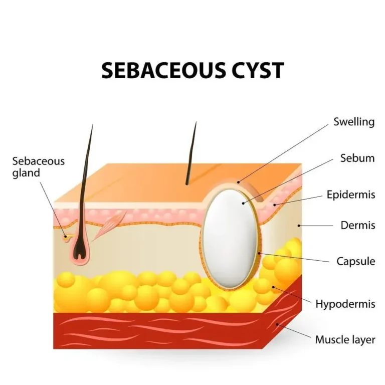 Sebaceous Cyst Treatment in Jaipur