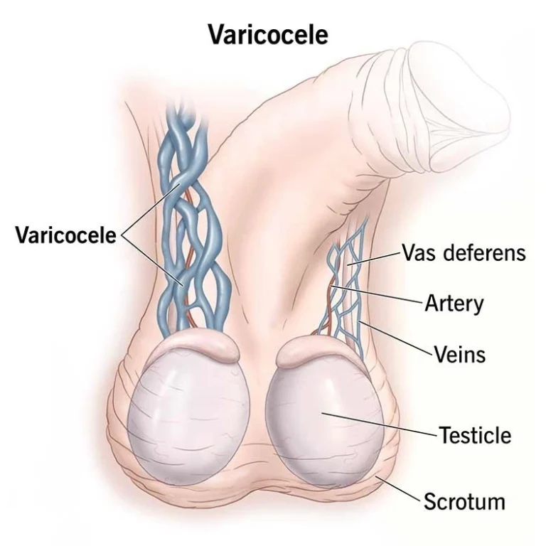 Varicocele Treatment in Jaipur